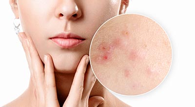 Professional Laser Skin Resurfacing Devices