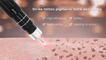 Lucrative Business Opportunity: Laser Tattoo Removal Cost And Profitability