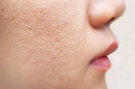 How Much Younger Does CO2 Laser Make You Look?