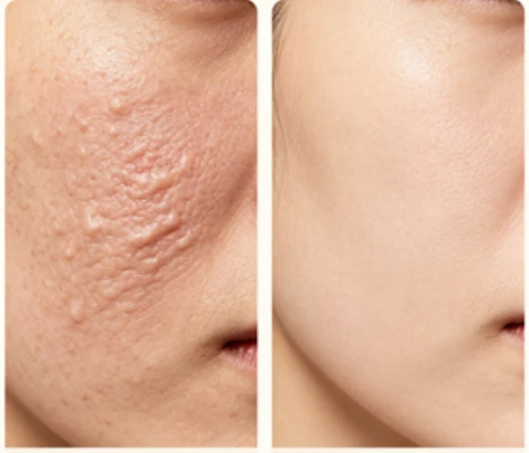fractional rf wrinkle removal fractional rf wrinkle removal