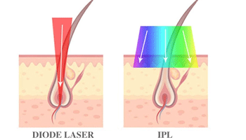 Which Is Better, An IPL Or A Diode Laser?