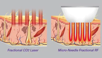 Which Is Better RF Microneedling Or CO2 Fractional Laser?