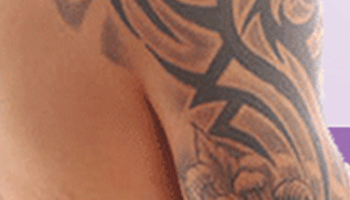 Laser Tattoo Removal Side Effects