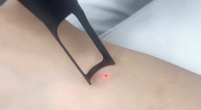 Is Laser Tattoo Removal Painful