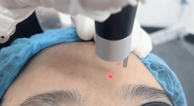 Laser Tattoo Removal Before And After