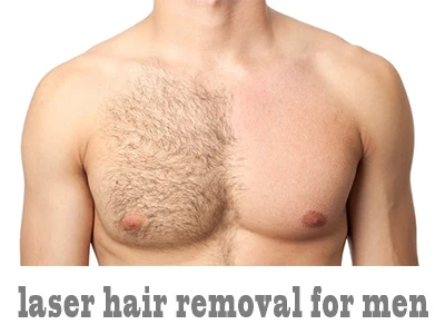 Laser Hair Removal For Men: Why It’s Gaining Popularity