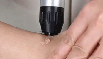 Shockwave Therapy For Muscle Pain