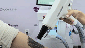 How Do I Take Care Of My Skin After A YAG Laser