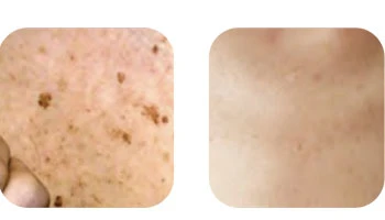 How Long Does Laser Take To Remove Pigmentation?