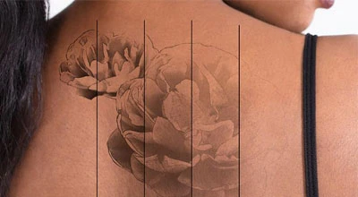 Who Can Get Tattoo Removal?