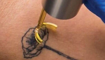 Is Picosecond Laser Worth It For Tattoo Removal?