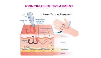 How Much Does A Tattoo Laser Removal Machine Cost