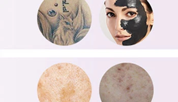 Safe Tattoo Removal With New Pico Lasers