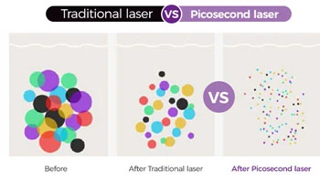 How Does Laser Tattoo Removal Work