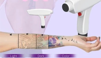 Top 10 Laser Tattoo Removal Machine in Japan
