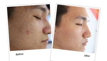 How Much Does Laser Skin Resurfacing Cost