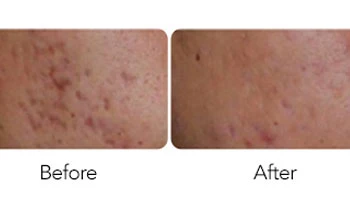 Microneedling With Radiofrequency Before And After