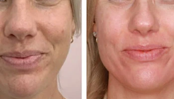 What Is The Best Age For RF Microneedling?