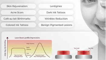 How To Remove A Tattoo With A Picosecond Laser?