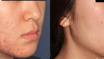 Non-Surgical Alternatives To Facelifts Using Fractional RF Microneedling