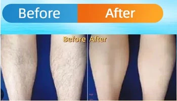 What To Expect After First Diode Laser Hair Removal