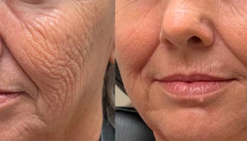 What Is The Average Cost Of Laser Skin Resurfacing
