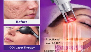 Can CO2 Laser Get Rid Of Acne Scars?