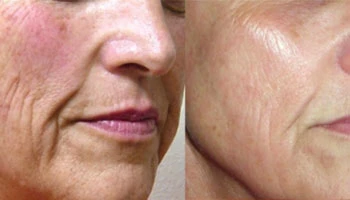 What Is The Most Effective Laser For Aging Skin?