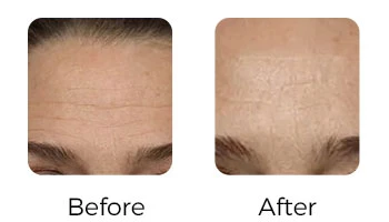 High ROI 12D HIFU For Clinics